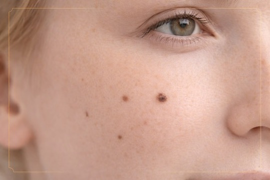 Skin moles